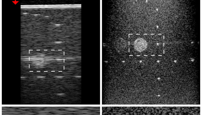 Un algoritmo migliora risoluzione immagini ecografiche