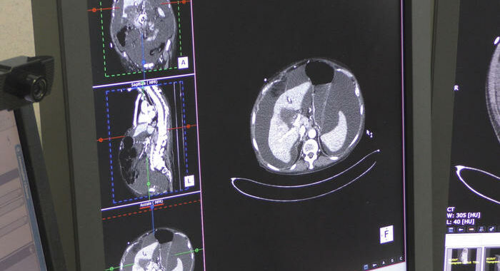 Oncologi, verso ondata casi avanzati per ritardi da pandemia