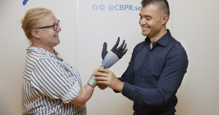 Come funziona la mano bionica